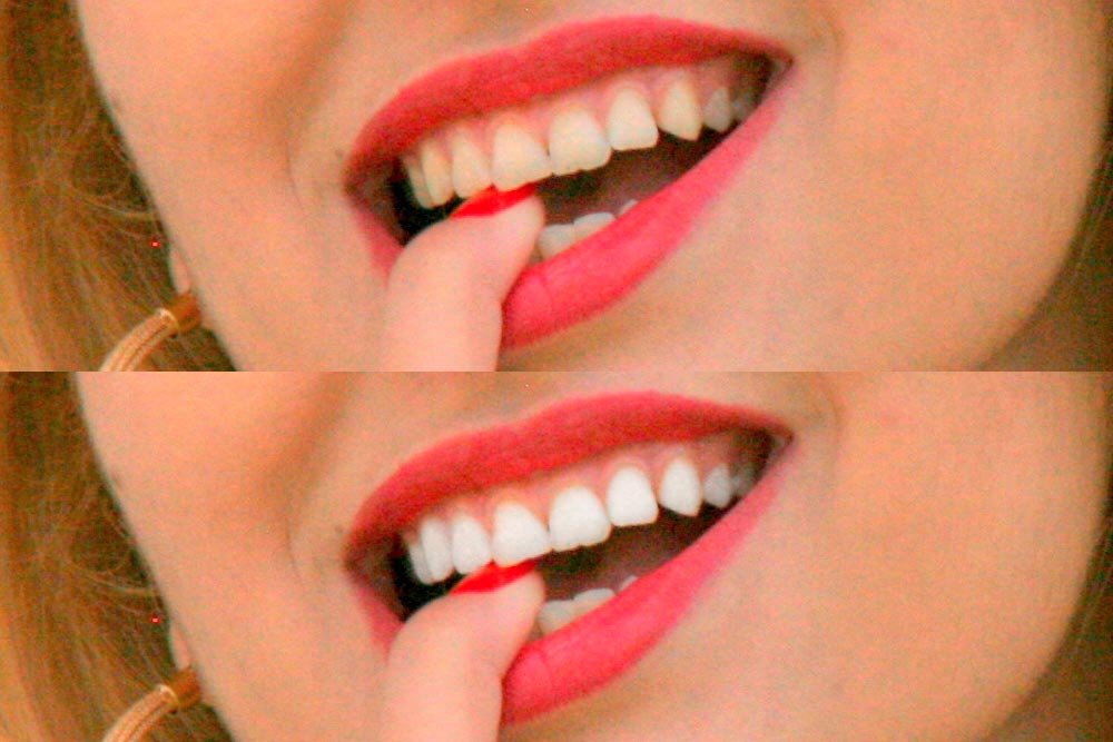 before-after-teeth.jpg